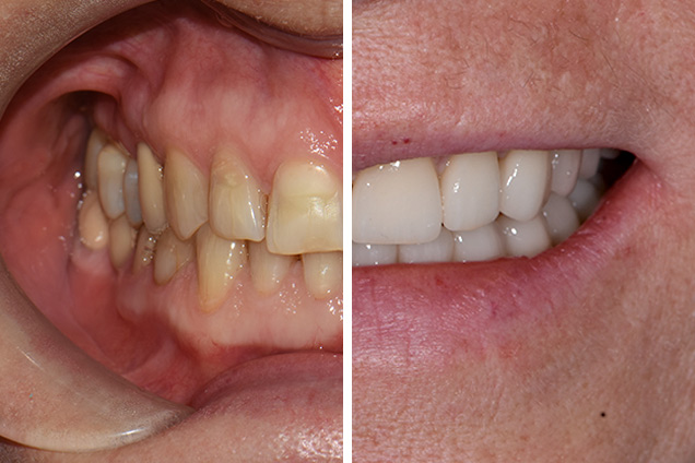 Вініри (прес-кераміка)