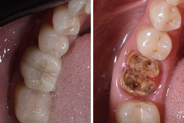 Коронка на імпланті