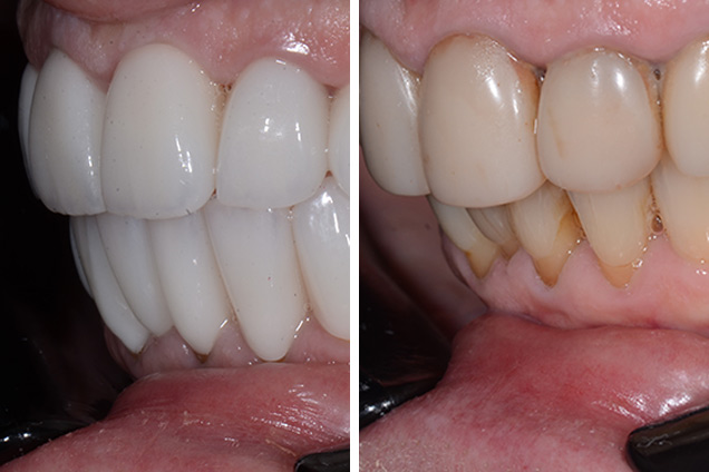 Коронки + вініри