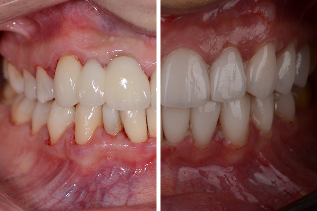 Встановлення вінірів