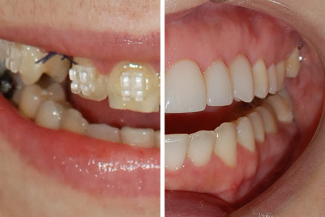 Реставрація і імпланти