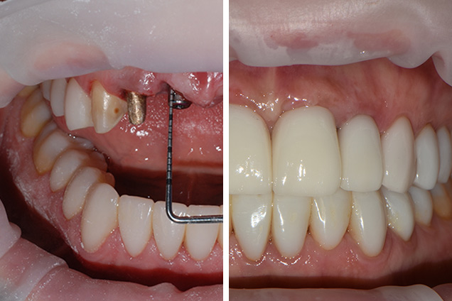 Імпланти і коронки