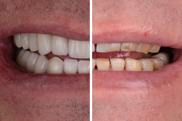 Вініри (прес-кераміка)