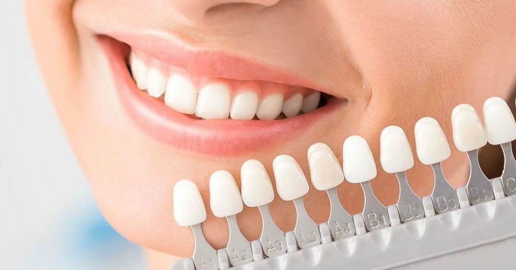 Виды виниров