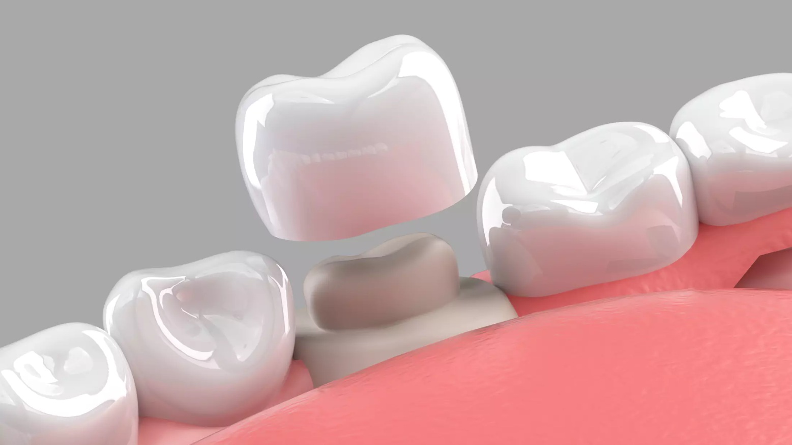 Скільки служить зубна коронка і від чого залежить термін її служби